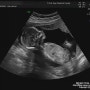 임신중기 5개월 16주차 증상 초음파 여전한 입덧 2차 기형아 검사