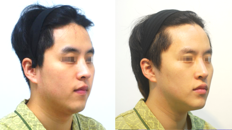 긴 얼굴 : 턱 길이를 줄이는 것은 '살처리'예요. (턱끝 묶기??) : 네이버 블로그