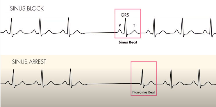 Sinus pause, Sinus arrest, SA node block : 네이버 블로그