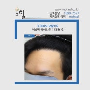 압구정 남자헤어라인교정 3000모이식