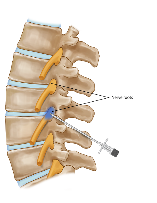 신경주사, 신경차단술, 말초신경 차단술, 신경통주사, peripheral nerve block : 네이버 블로그