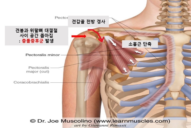 소흉근 Pectoralis Minor 단축과 스트레칭법 네이버 블로그