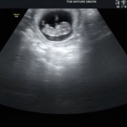 임신초기증상:: 임신 중 배땡김과 식욕 원상복구(10w4d)