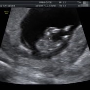 임신초기 :: 1차 기형아검사, 그리고 초음파사진 각도법으로 예측하는 아기 성별(11w6d)