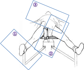A2FN(Expert A2FN. Designed for small statured patients) : 네이버 블로그