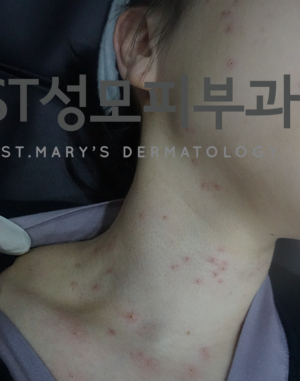 [삼성동피부과] 피부과전문의가 설명하는 쥐젖 제거 레이저 : 네이버 블로그