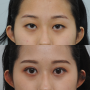 안검하수 교정을 위한 절개 눈매교정 수술 (ft. 5개월차 후기 및 흉터)