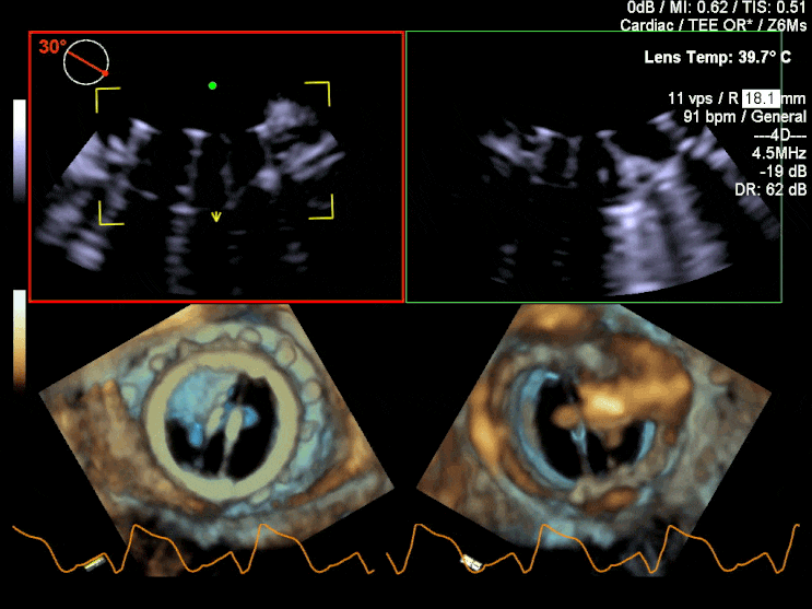 MVR(mitral valve replacement.) : 네이버 블로그