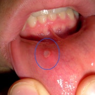 [종로 센트럴 약국] 건강상식 이야기 두번째 "구내염(oral ulcer)"