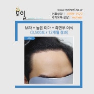 남자 높은이마교정, 3500모 모발이식으로 커버