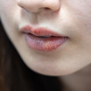 입술 염증은 립밤으로 간편하게 해결? (구순염, 입술각질, 립밤추천)