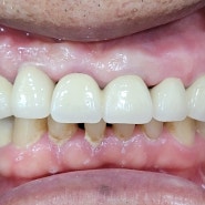 원주 치과, 전치부 롱 브릿지 파절로 인한 재치료 case