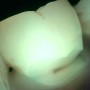 치아 잇몸 패임으로 인한 치아시림, 치아뿌리부분의 굴곡파절 때문?