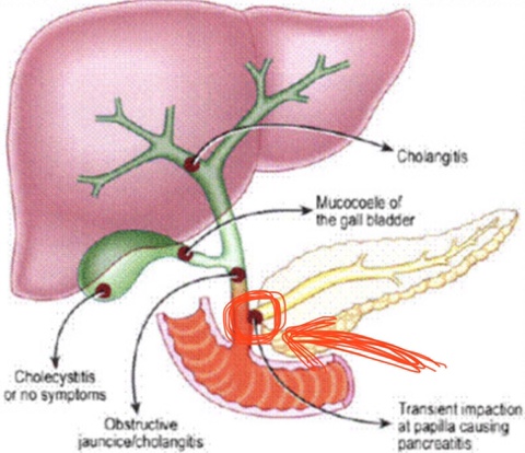 급성 췌장염 (Acute pancreatitis) - 복통, 담석, 술 그리고 중성지방 : 네이버 블로그