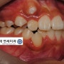 천천동 호매실동 치과인 미래연세치과에서 상악견치(송곳니) 매복치의 치아교정방법