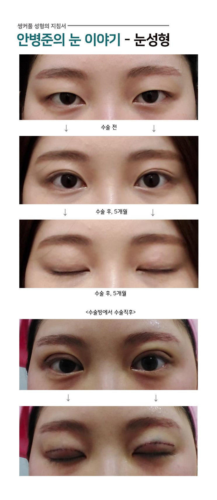 가장 이상적인 쌍꺼풀수술(쌍수,예쁜쌍수) : 네이버 블로그