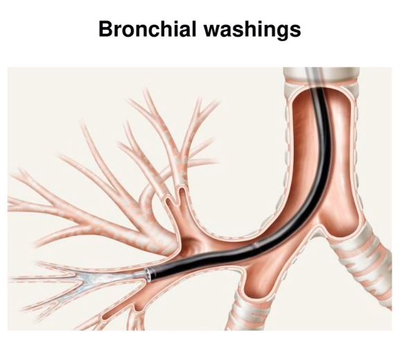 [기관지경 술기]1. Bronchial washing 기관지 세척술 : 네이버 블로그