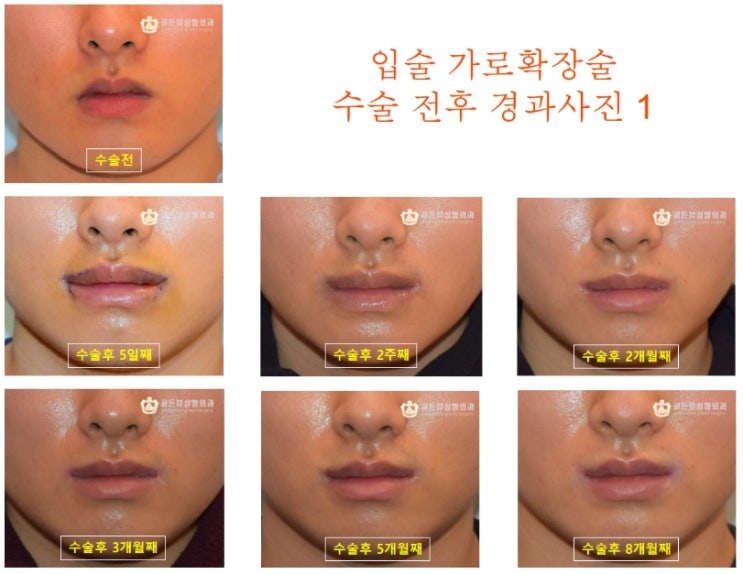 입술가로길이확장 입커지는방법 남자입꼬리수술 8개월 차 수술 전 후 분석하기 : 네이버 블로그