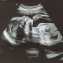 임신중기 6개월 20~23주차 증상 아기 성별확인