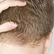 FUE Hair Transplantation: The Tool Makes the Difference