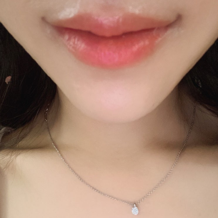 입꼬리수술, 입술필러 전후비교 내돈내산 솔직후기 : 네이버 블로그