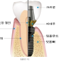 [전주혁신도시치과] 임플란트가 흔들려요!!