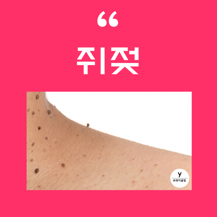 쥐젖 제거 5가지방법! 사타구니 쥐젖 원인 , 물사마귀 편평사마귀와 차이 : 네이버 블로그
