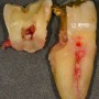 방치된 치아크랙, 치아파절로 이어져 발치할 수 밖에 없었던 사례들