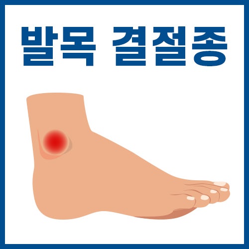 발목 물혹, 복숭아뼈 물혹, 발목 결절종 치료방법 : 네이버 블로그