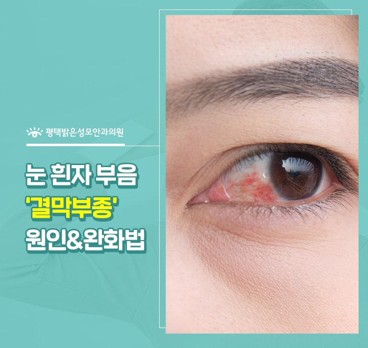 평택안과 눈 흰자 부음 결막부종 원인 & 완화법 : 네이버 블로그