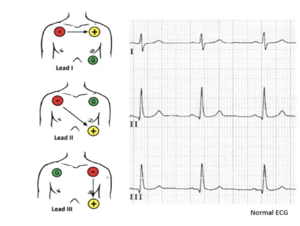 EKG 공부하기 : 네이버 블로그