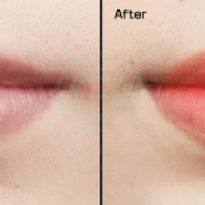 입술색소침착의 원인과 치료법 그리고 예방(보랏빛 입술이신 분 필독)