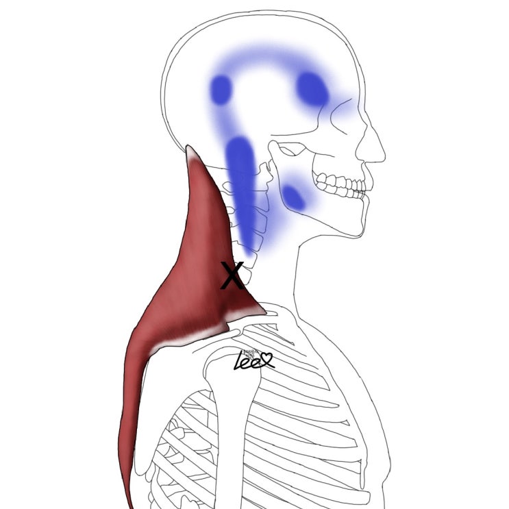 승모근(등세모근, Trapezius)의 통증유발점(Trigger point) : 네이버 블로그