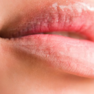 입술건조증으로 인한 입술 껍질과주름의 갈라짐 현상이 발생하는 원인과 치료법(립밤 광고 x)