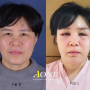 Progress after endoscopic forehead and brow lift and lower blepharoplasty
