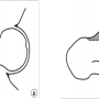 고관절(대퇴비구) 충돌증후군 (Femoroacetabular Impingement Syndrome)