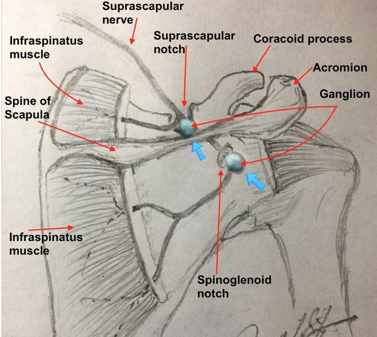 등, 견갑골(scapula) 부위가 아파요. 상견갑신경차단술(Suprascapular nerve block) : 네이버 블로그