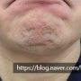 [삼성동 피부과] 피부과 전문의가 설명하는 자갈턱보톡스 (턱끝보톡스) - ST성모피부과