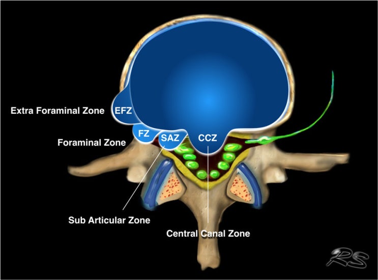 권선동 교통사고 한의원 - subarticular protrusion 디스크 환자의 발목까지 내려오는 통증 : 네이버 블로그