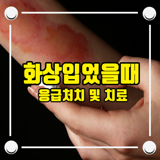 화상 입었을때 화상응급처치 및 1도 2도 3도 화상 연고 치료 : 네이버 블로그