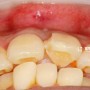 앞니금+앞니깨짐 : 치아 파절을 세라믹 크라운으로 치료하다, 삼성중앙역 치과