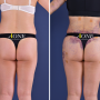 Liposuction and hip-up surgery