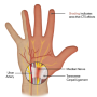 손목터널증후군 환자 치료 사례 (CTS, 근전도 검사 등)