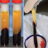 당뇨 임플란트치과추천 : 잇몸뼈이식 치조골이식수술(ARP, Alveolar Ridge Preservation)