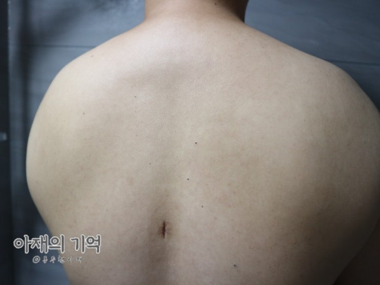 나의 표피낭종 제거 수술 후 피지낭종 흉터 관리 이야기 : 네이버 블로그