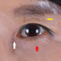 Correction of aging in the periocular (around the eye area)