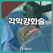 [대전 유성 새봄안과] 각막 강화술이란?