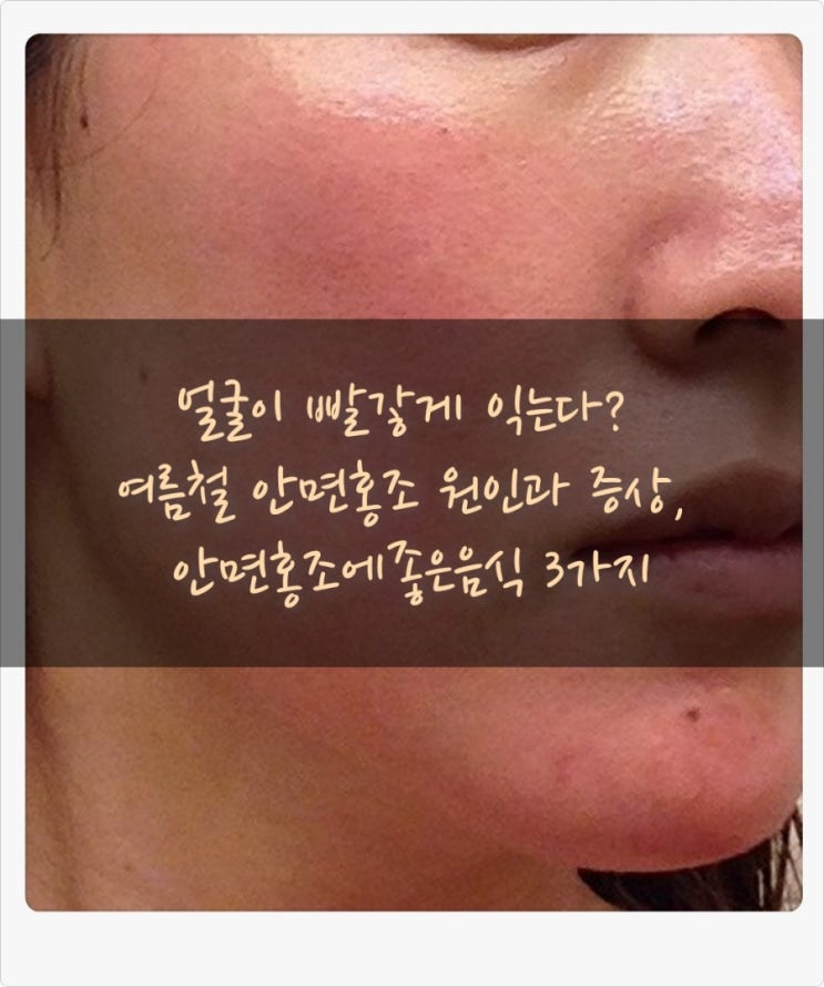 얼굴이 빨갛게 익는다? 여름철 안면홍조원인과 증상, 안면홍조에좋은음식 3가지 : 네이버 블로그