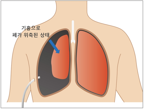 기흉이란? 기흉의 진단과 치료 : 네이버 블로그
