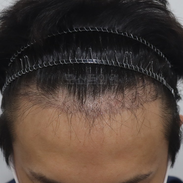 모발이식암흑기 언제부터 시작일까? : 네이버 블로그